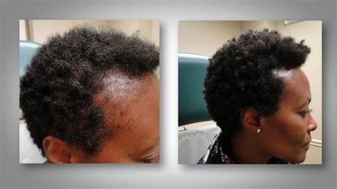 Fake fullness with these easy, pretty the pins holding the sides of her hair in place are also helping to prop up the front of her hair for. PRP Hair Restoration in Scottdale & Phoenix, AZ - MD Skin ...