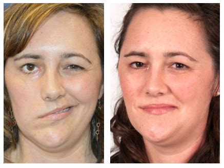 Patient Experiences Great Results After First Step Of Two Part Facial Paralysis Surgery
