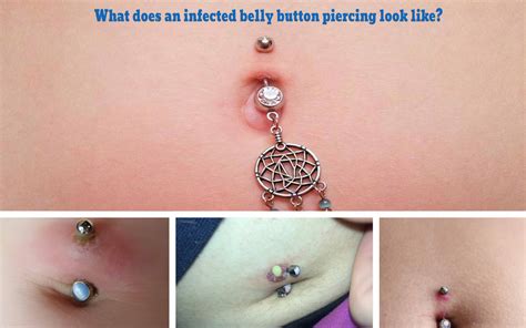 How Do You Treat An Infected Belly Button