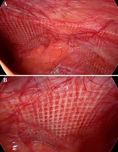 Laparoscopic Repair Of Inguinal Hernia Healthcare My XXX Hot Girl