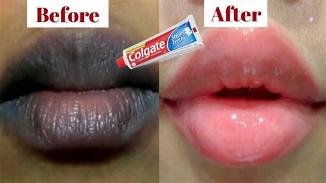 How To Lighten Dark Lips Naturally At Home With Toothpaste How To Get