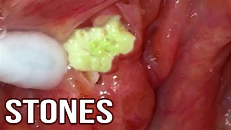 Tonsil stones, also called tonsilloliths, begin as soft, white clumps that might not even be visible. Compilation of My Extreme Tonsil Stones, 2018 - YouTube