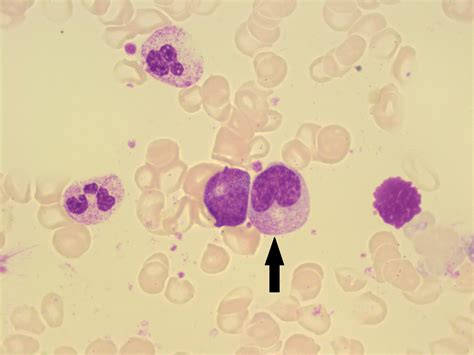 Myelocyte And Metamyelocyte