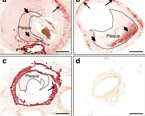 Intimal And Medial Vascular Calcification In Peripheral Arteries