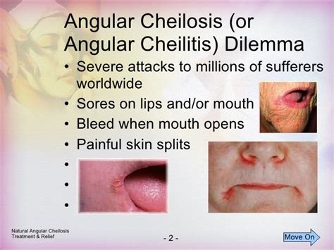 Cheilosis And Angular Cheilosis Treatment Natural Treatment For Ang