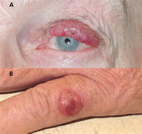 Sun exposure and having a weak immune system can affect the risk of merkel cell carcinoma. Milestones in the Staging, Classification, and Biology of ...