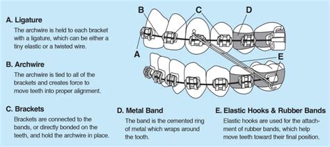 Orthodontic Emergencies Magnolia Orthodontics