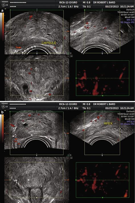 Diagnostic Ultrasound Imaging Of The Prostate Radiology Key
