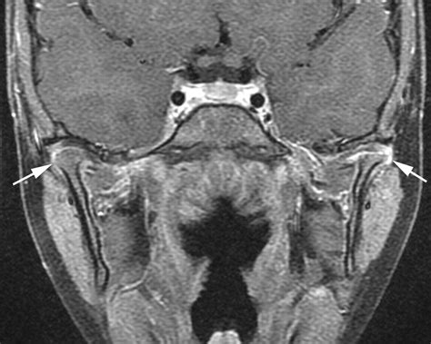 Temporomandibular Joint Involvement In Children With Juvenile