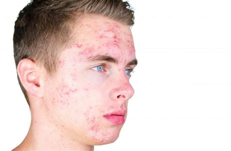 What Is The Cause Of Acne With Pictures