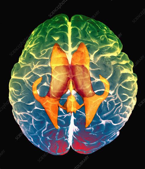 Ventricles Of Brain Mri Stock Image P3320371 Science Photo Library