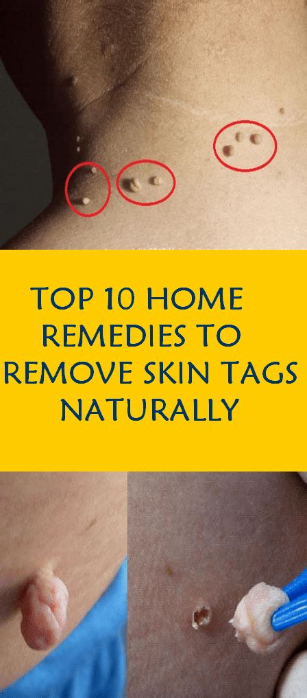top 10 home remedies to remove skin tags naturally yourhealthbodies