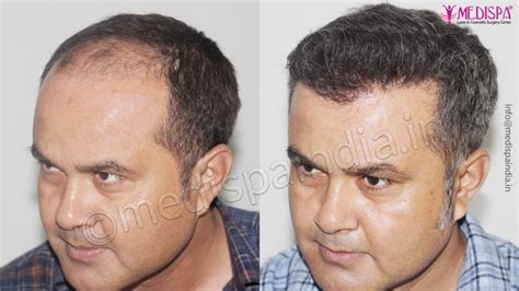 Best Hair Transplant Results Dubai Uae Medispa India