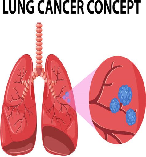120 Lung Cancer Clip Art Stock Illustrations Royalty Free Vector