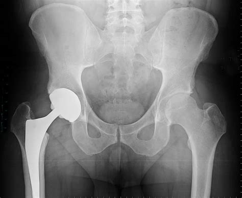 430 Hip Replacement Xray Stock Photos Pictures And Royalty Free Images