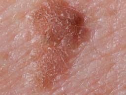 Different Types Of Keratosis Skin Lesions
