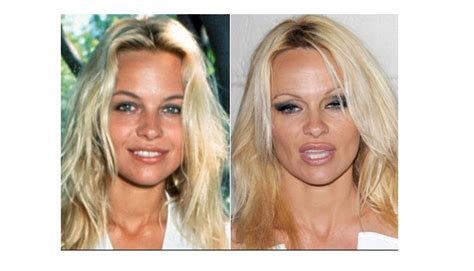 Pamela Anderson Five Celebrities Who Have Gone Under The Knife