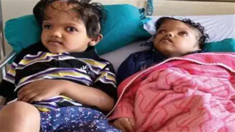 Delhi Conjoined Twins Who Came From Odisha Ready To Lead Separate