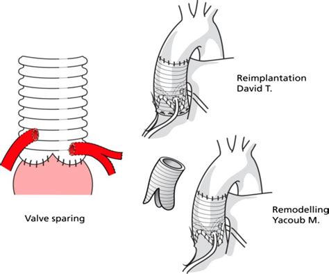 The David And Yacoub Valve Sparing Techniques For Aortic Root