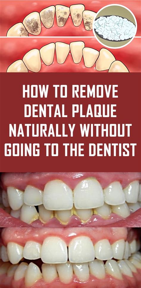 Awasome How To Remove Teeth Plaque Home Remedies References