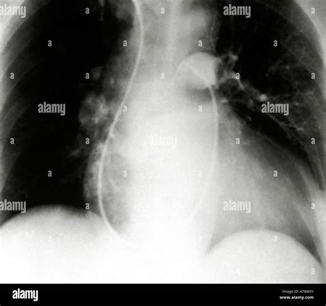 Pulmonary Angiogram X Ray Pulmonary Embolism Stock Photo Alamy
