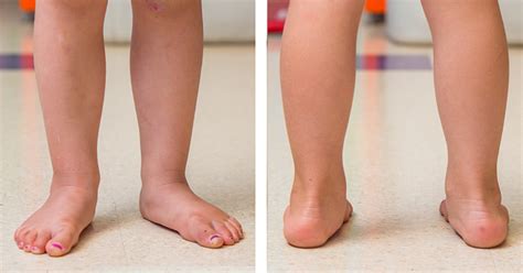 Toddlers Feet Turn Inward Pre School Plan