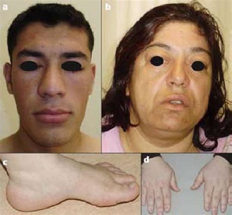 acromegaly progression