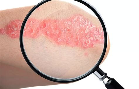 Fda Approves Spesolimab For Treatment Of Generalized Pustular Psoriasis