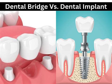 Dental Bridge Vs Dental Implant Advantages And Disadvantages