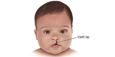 What Is A Cleft Lip Know All About It And How You Can