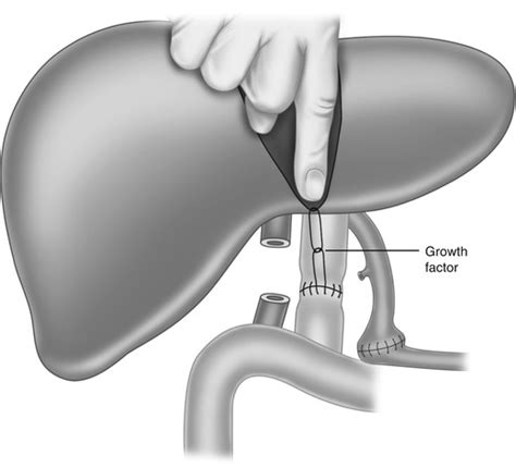 Liver Transplantation Basicmedical Key