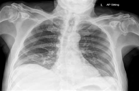 Erect Chest X Ray No Free Air Under Diaphragm Download Scientific