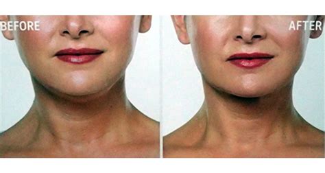 Double Chin Injections The Truth About Fat Dissolving Injections