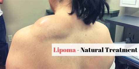 Know About Natural Lipoma Treatment At Home