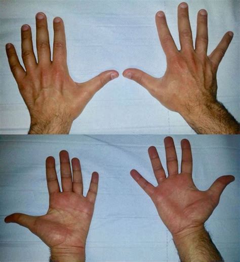 Ulnar Nerve Hand Deformity