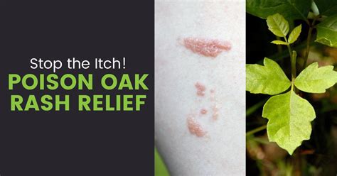 Poison Oak Rash Symptoms 5 Soothing Natural Treatments Dr Axe
