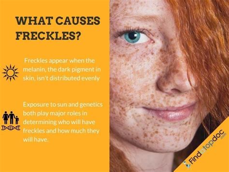 What Causes Freckles Findatopdoc