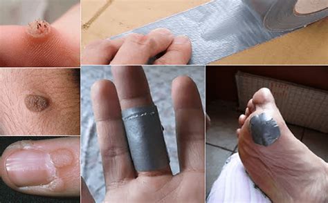 How Does Duct Tape Remove Warts Paradox
