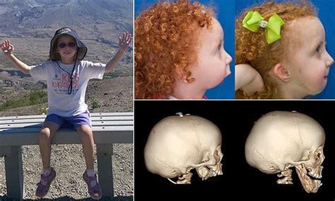 Little Girl Born With No Lower Jaw Bone Endures 11 Operations To