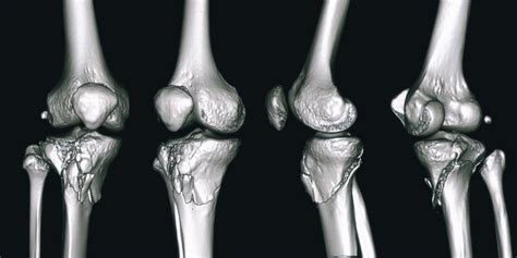 Femoral Tibial Joint