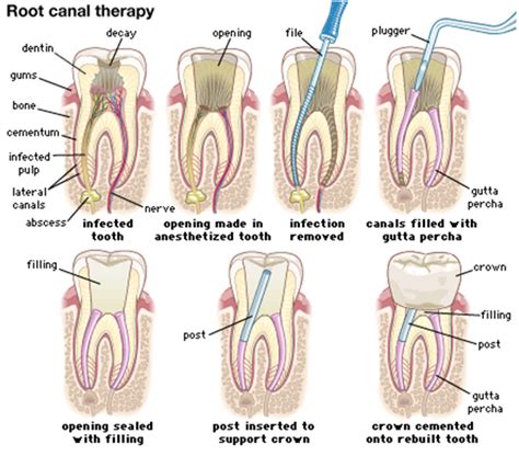 There are several websites online that provide inexpensive dental the average cost of a root canal and crown, which includes a permanent cap placed on the the crown, however, is usually necessary, since it extends the tooth's life and general health at. Root Canal Treatment | Kid Focus Dentistry