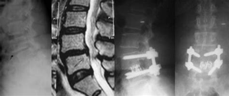 Spondylolisthesis Surgery Before And After