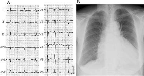 Figure 2 From Primary Cardiac Diffuse Large B Cell Lymphoma Promptly