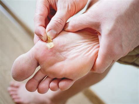 What To Expect With Plantar Warts Treatment Bryon Butts Dpm Podiatrist