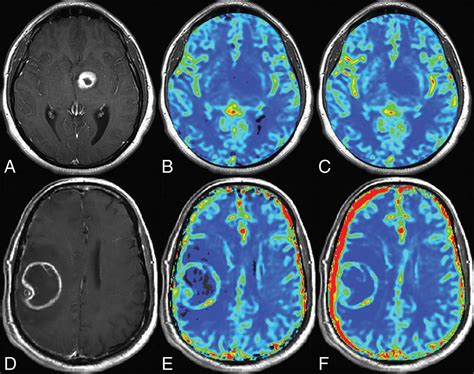 Multisite Concordance of DSC-MRI Analysis for Brain Tumors: Results of 