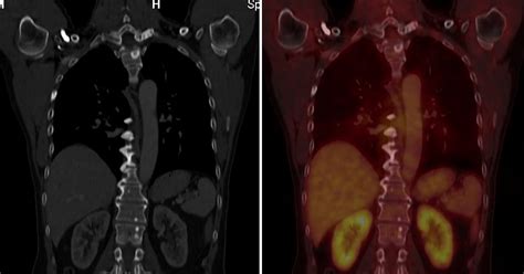 Radiodiagnosis Imaging Is Amazing Interesting Cases Carcinoma