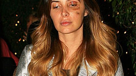 Brittny Gastineau Gets Black Eye After Physical Fight With Artist
