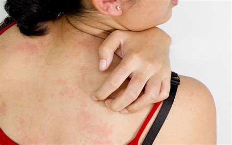 How To Know Your Dry Irritated Skin Is Actually Eczema Page 2 Of 5
