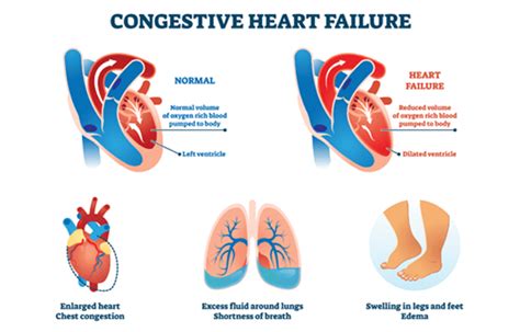 Congestive Heart Failure Chf Symptoms Causes Treatment Medicine