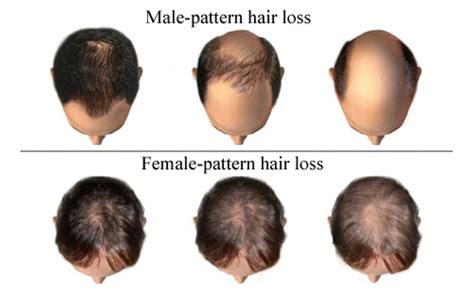 What Are The Different Types Of Alopecia Hair Loss Restoration My XXX
